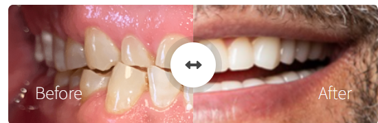 Single Tooth Implant
