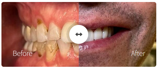 Full Arch Restoration